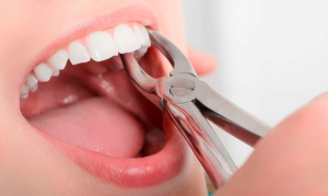 Có nên giữ lại răng sau khi nhổ không