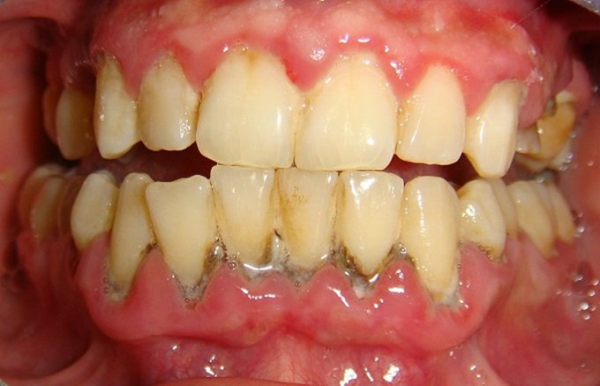 Cao răng có thể gây ra nhiều vấn đề nếu chúng không được quản lý cẩn thận Cao răng có thể gây ra nhiều vấn đề nếu chúng không được quản lý cẩn thận
