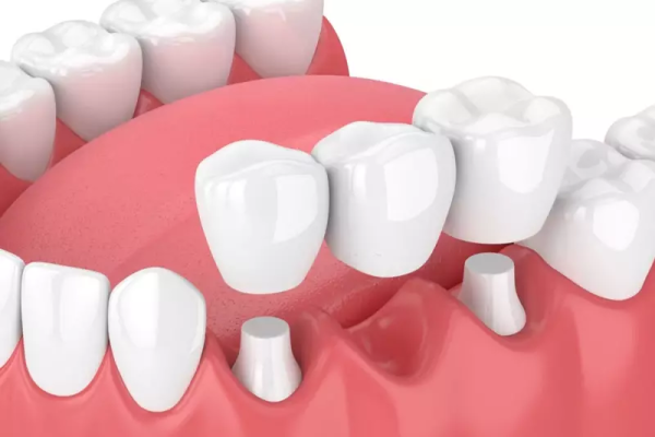 Làm cầu răng sứ giá bao nhiêu?