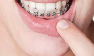 niềng răng 1 hàm có được không