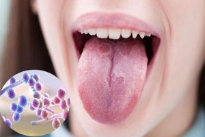 Nấm lưỡi: Nguyên nhân, dấu hiệu và cách điều trị triệt để