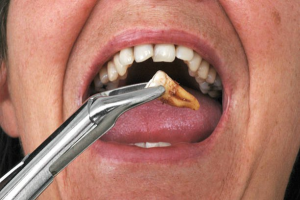 Nhổ răng hàm trên có nguy hiểm không? Có ảnh hướng sức khỏe không?