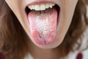 Rát lưỡi là bệnh gì? Dấu hiệu, nguyên nhân, cách khắc phục