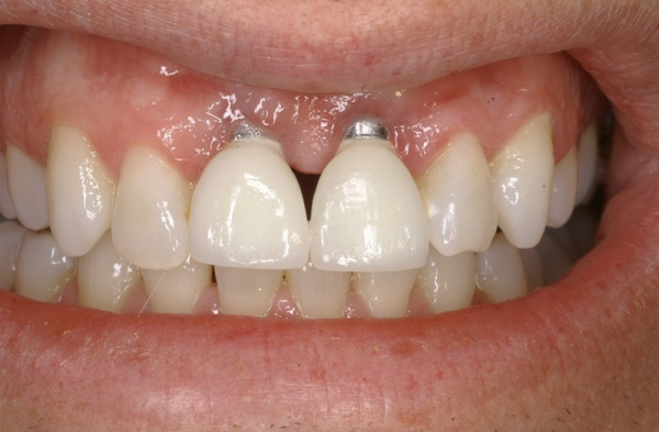Sau khi nhổ răng bao lâu thì trồng implant? Trồng răng Implant sau mất răng giúp cải thiện vẻ ngoài, hạn chế các bệnh răng miệng