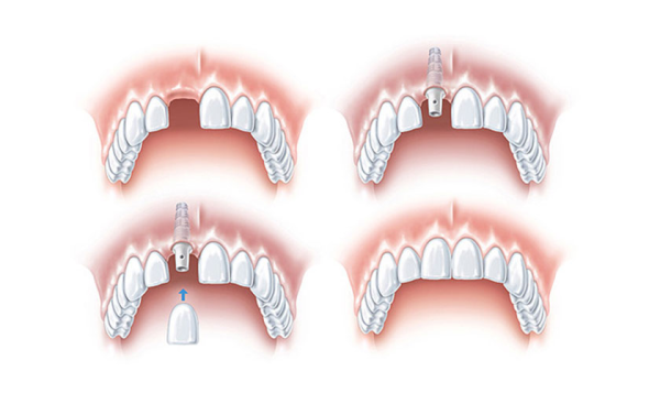 Sau khi nhổ răng bao lâu thì trồng implant? Công nghệ Implant tức thì cho phép cấy ghép Implant ngay tại lỗ ổ răng vừa nhổ