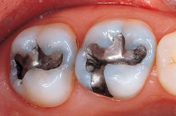 Thời gian trám răng có bền không phụ thuộc vào vật liệu trám, công nghệ và chăm sóc