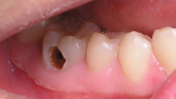 Do bệnh lý về răng miệng Do bệnh lý về răng miệng