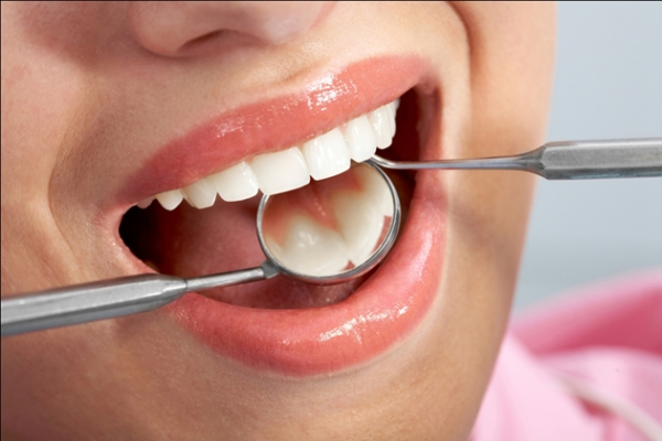 Do lấy cao răng nha sĩ có thể vô tình làm tổn thương, gây ê buốt sau khi trám răng Do lấy cao răng nha sĩ có thể vô tình làm tổn thương, gây ê buốt sau khi trám răng
