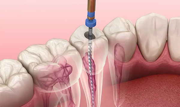 Nếu điều trị tủy không triệt để trước khi trám sẽ bị viêm và gây ê buốt Nếu điều trị tủy không triệt để trước khi trám sẽ bị viêm và gây ê buốt