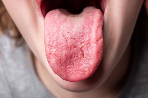 Tưa lưỡi ở người lớn và trẻ nhỏ: Nguyên nhân và cách điều trị