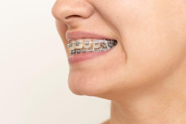 Những ai nên gắn band răng?