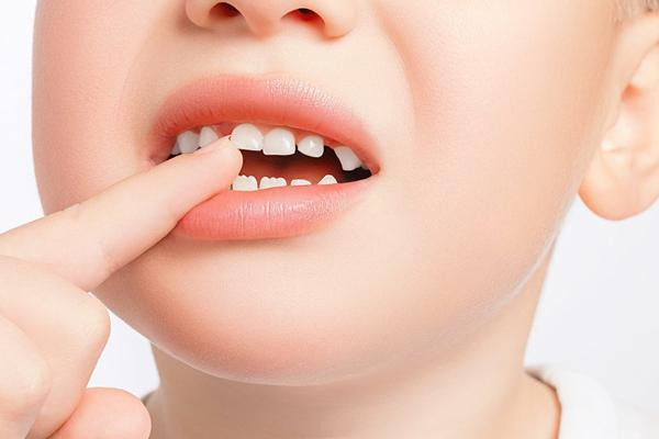 Các nguyên nhân khiến răng mọc lệch