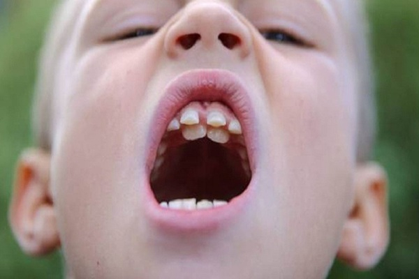 Răng mọc lệch có nguy hiểm không?
