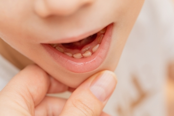 Răng trẻ mọc lệch phải làm sao?