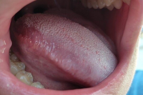 Bệnh viêm gai lưỡi là gì? Bệnh viêm gai lưỡi là gì?