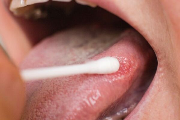 Tình trạng viêm gai lưỡi bị sưng đỏ Tình trạng viêm gai lưỡi bị sưng đỏ