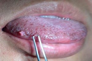 Hình ảnh viêm gai lưỡi