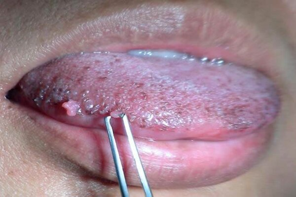 Tình trạng viêm gai lưỡi nổi nhiều mụn to Tình trạng viêm gai lưỡi nổi nhiều mụn to