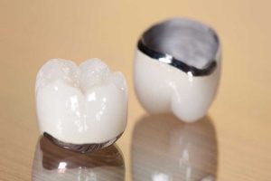 Mão răng là gì? Các loại mão sứ và bảng giá mới nhất