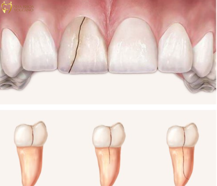 Nứt ở đỉnh răng