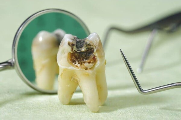 Dấu hiệu nhận biết răng bị mục Dấu hiệu nhận biết răng bị mục
