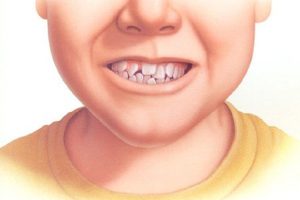 Răng lệch lạc là gì? Phương pháp điều trị nào phù hợp nhất?