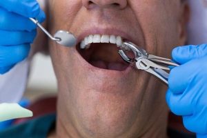 Sau khi nhổ răng bao lâu thì được ăn? Những điều cần lưu ý