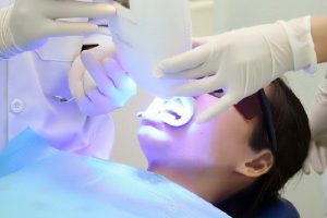 Tẩy trắng răng Laser Whitening là gì? Có an toàn hay không?
