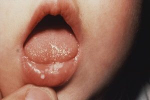 Trẻ sơ sinh bị nhiệt miệng: Cách chăm sóc và điều trị hiệu quả