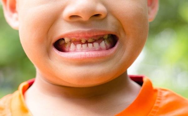 30 Trường học và gần 100.000 học sinh đã được Đồng Dental thăm khám Nha khoa học đường