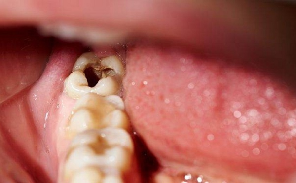 Do các bệnh lý khác về răng miệng Do các bệnh lý khác về răng miệng