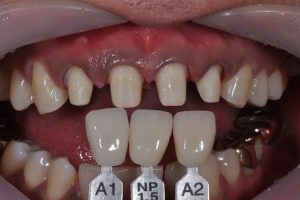 20+ Hình ảnh răng sau khi mài có thể bạn chưa biết