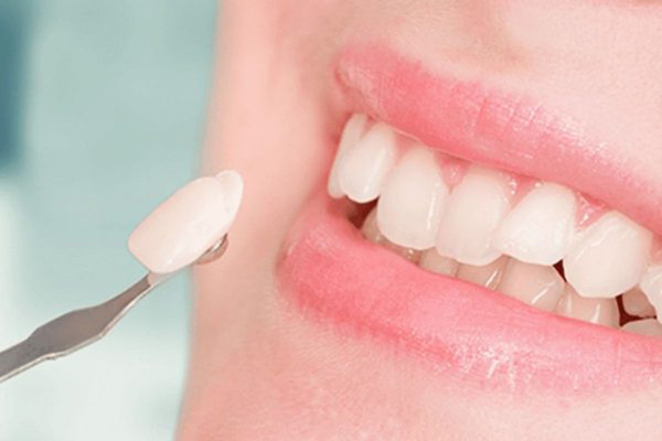 Hình ảnh răng sau khi mài và dán sứ
