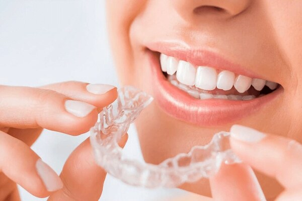 Các bước niềng răng ngay tại nhà với phương pháp niềng invisalign