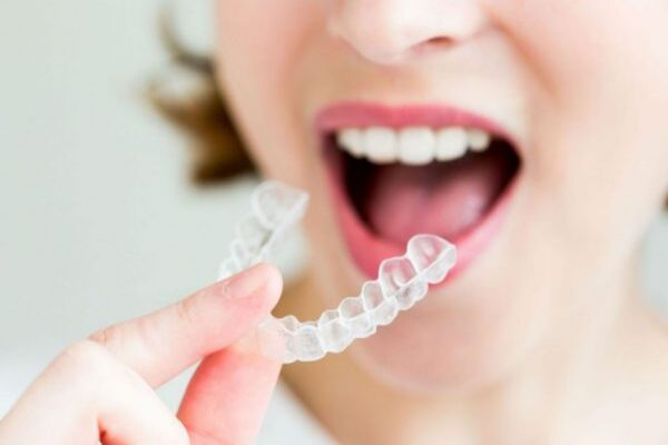 Chi phí niềng răng có đắt không? Chi phí niềng răng có đắt không?