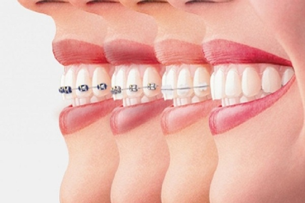 Các phương pháp niềng răng vô hình hiện nay