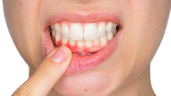 Sưng nướu do các bệnh lý về răng khác gây nên