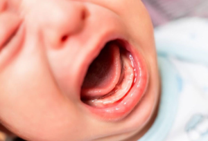 Trẻ sốt mọc răng 39 độ nguy hiểm không? Bố mẹ cần lưu ý gì?