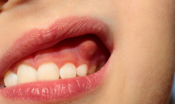 Nướu xuất hiện các túi mủ Nướu xuất hiện các túi mủ