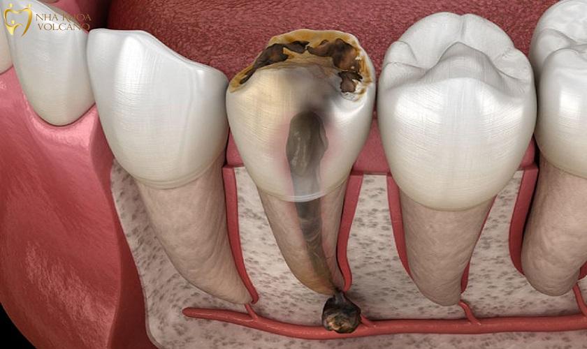 Những triệu chứng của viêm tủy răng
