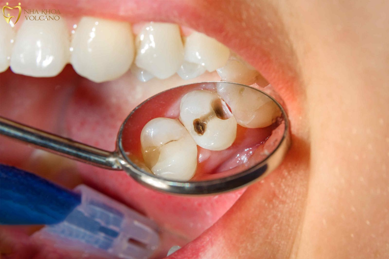 triệu chứng sau khi lấy tủy răng