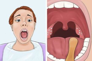 6 cách lấy sỏi amidan tại nhà và các biện pháp ngăn ngừa sỏi amidan hiệu quả
