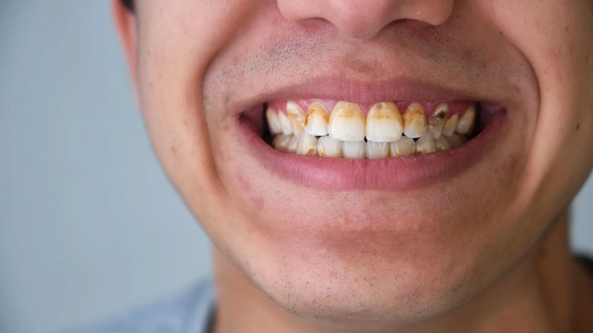 Loại bỏ cặn bã và vết ố trên răng Loại bỏ cặn bã và vết ố trên răng