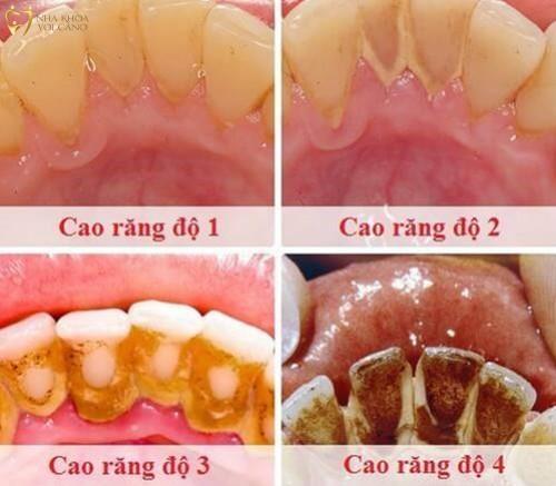 Các cấp độ cao răng Các cấp độ cao răng