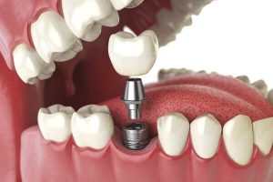 Chú ý: Hối hận khi trồng răng Implant quá trễ