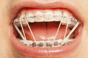 Chun liên hàm: Bí quyết duy trì sức khỏe và những lưu ý khi đeo thun liên hàm