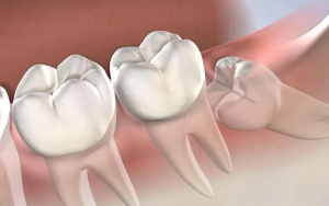 răng khôn mọc lệch nhưng không đau có nên nhổ