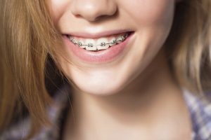 Nẹp răng là gì? Các loại nẹp răng? Lợi ích khi nẹp răng