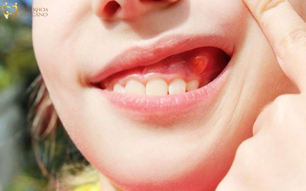 Các vị trí sưng nướu răng thường gặp Các vị trí sưng nướu răng thường gặp