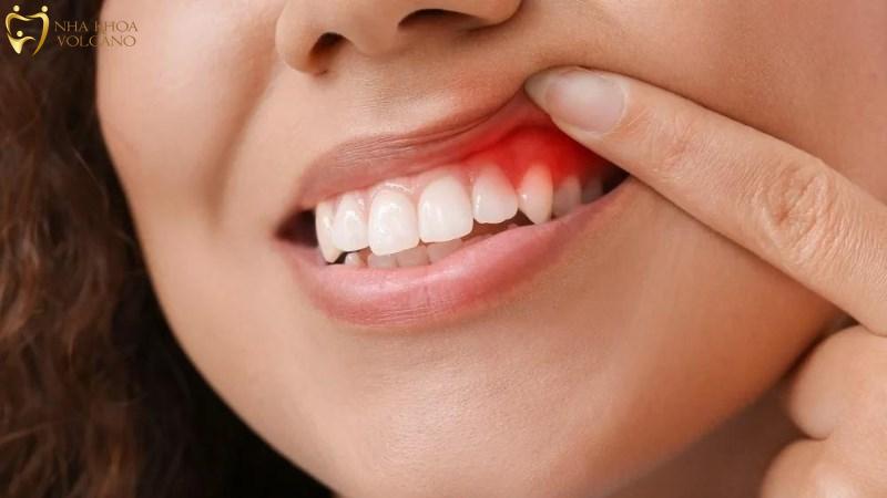 Cách giảm đau khi bị sưng nướu răng Cách giảm đau khi bị sưng nướu răng